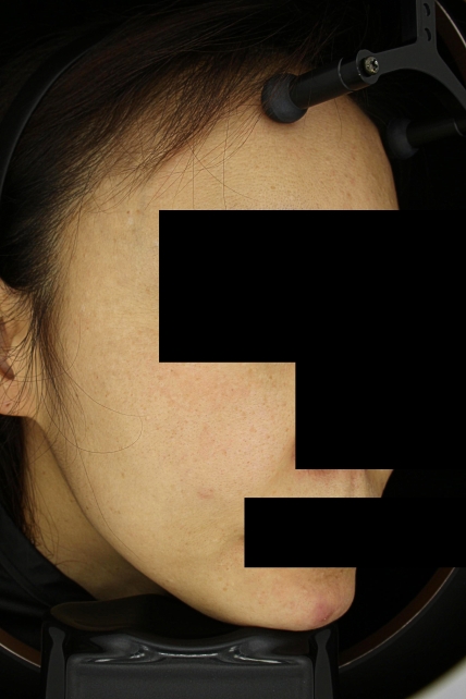 기미·색소 치료 후 사진 03