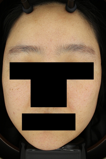 기미·색소 치료 후 대표 사진 57