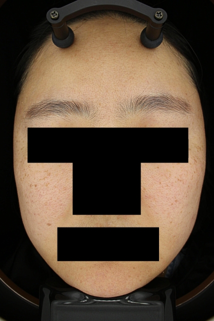 기미·색소 치료 전 대표 사진 57