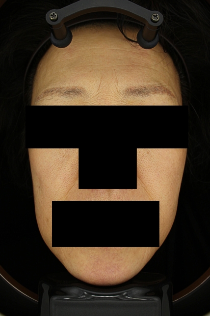 기미·색소 치료 후 대표 사진 58