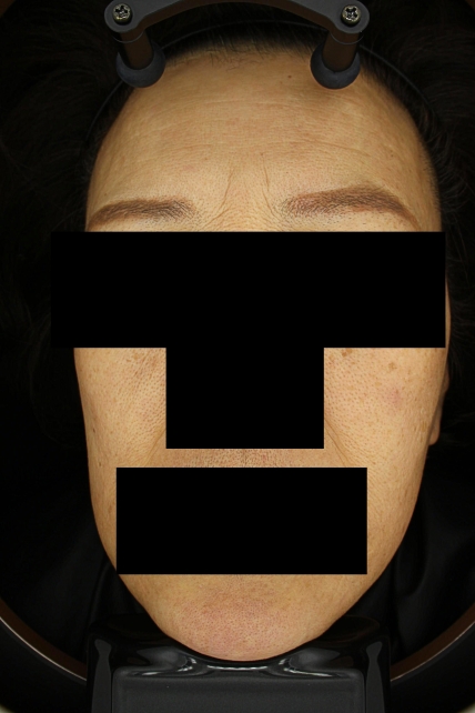기미·색소 치료 전 대표 사진 58