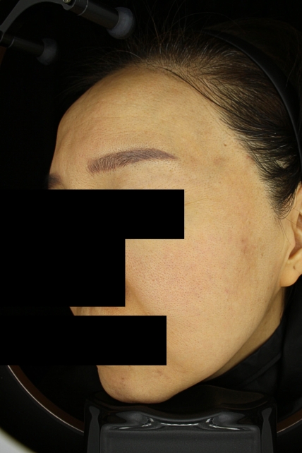 기미·색소 치료 후 사진 02
