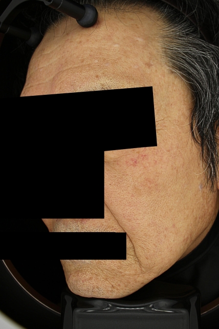 기미·색소 치료 후 사진 02