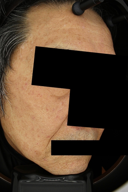 기미·색소 치료 후 사진 03