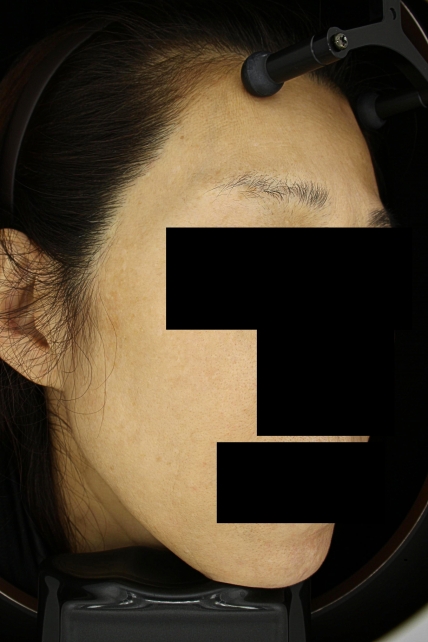 기미·색소 치료 후 사진 03