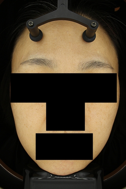 기미·색소 치료 후 대표 사진 62