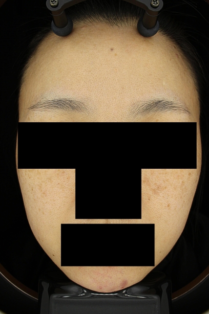 기미·색소 치료 전 대표 사진 62