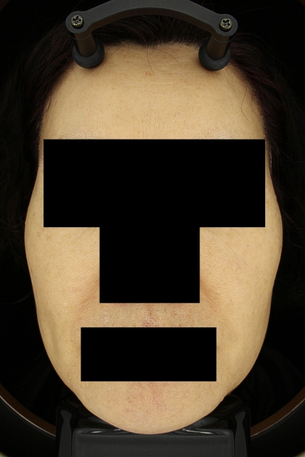 기미·색소 치료 후 대표 사진 63