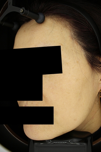 기미·색소 치료 후 사진 02