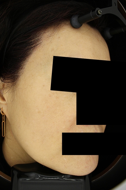 기미·색소 치료 후 사진 03