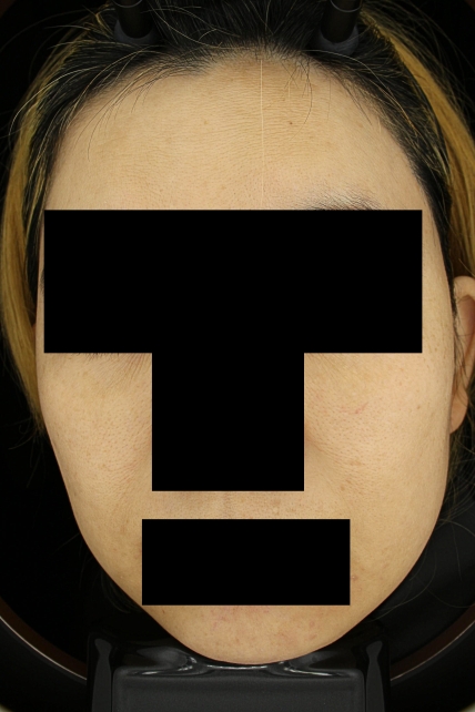 기미·색소 치료 후 대표 사진 64