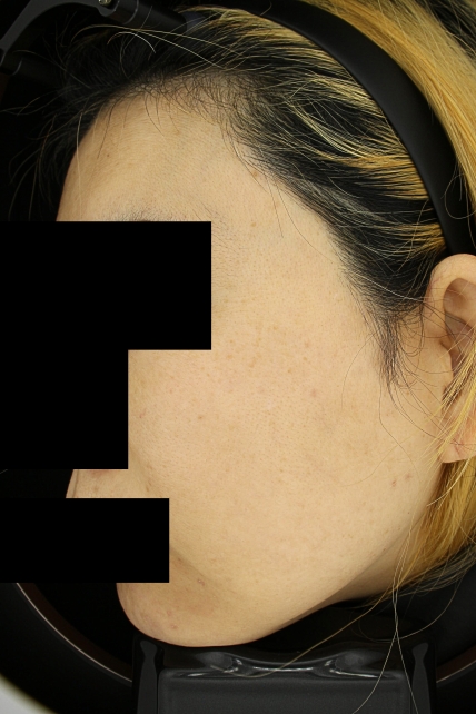 기미·색소 치료 후 사진 02