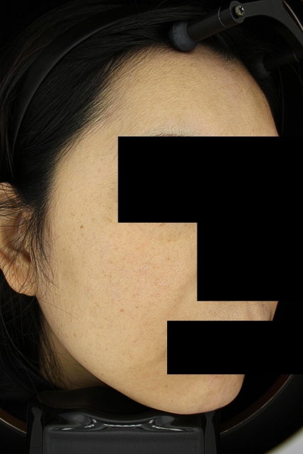 기미·색소 치료 전 사진 03