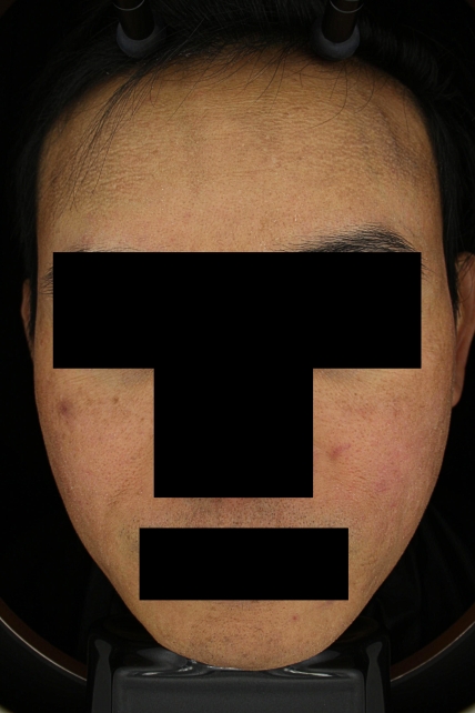 기미·색소 치료 후 대표 사진 65
