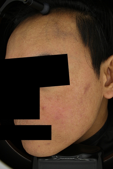 기미·색소 치료 후 사진 02