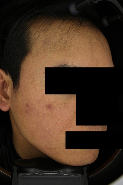 기미·색소 치료 후 사진 03