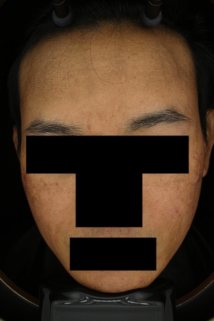 기미·색소 치료 전 대표 사진 65