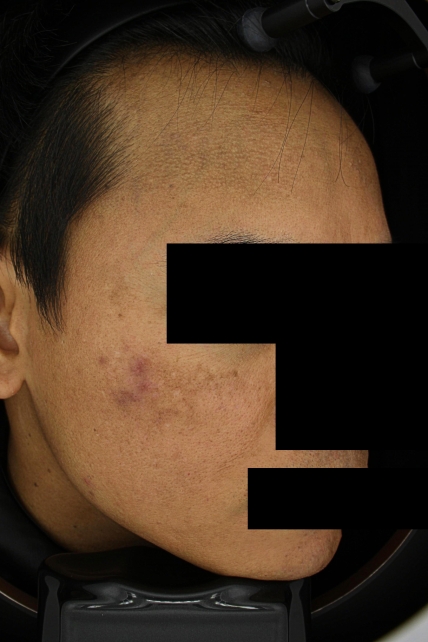 기미·색소 치료 전 사진 03