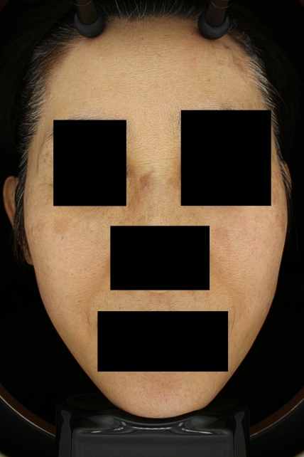 기미·색소 치료 후 대표 사진 66