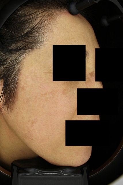 기미·색소 치료 후 사진 03