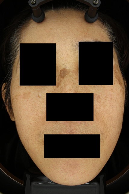 기미·색소 치료 전 대표 사진 66