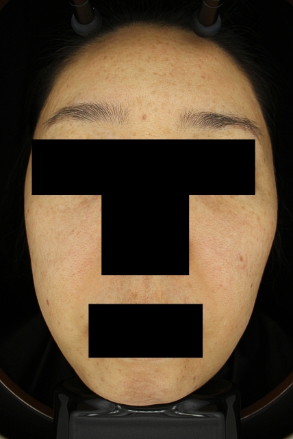 기미·색소 치료 후 대표 사진 67