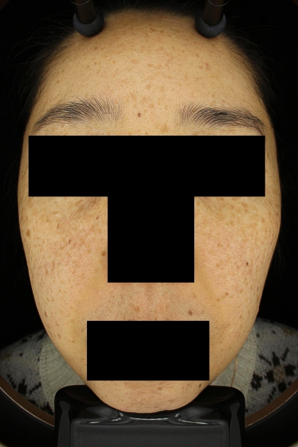 기미·색소 치료 전 대표 사진 67