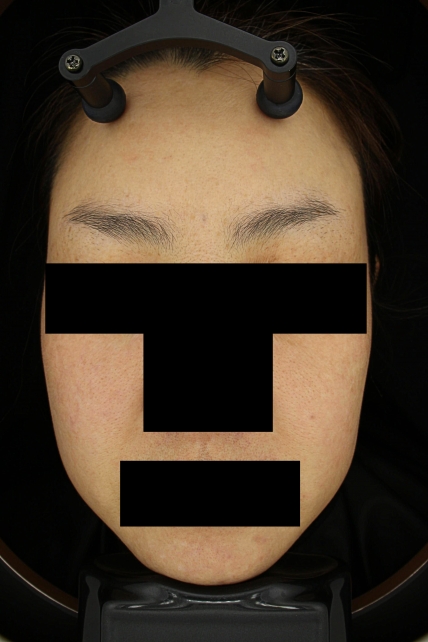 기미·색소 치료 후 대표 사진 68