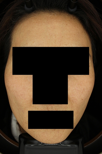 기미·색소 치료 후 대표 사진 69