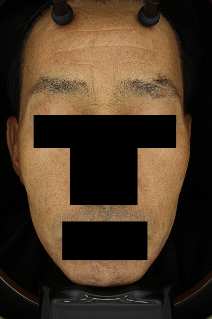 기미·색소 치료 후 대표 사진 70