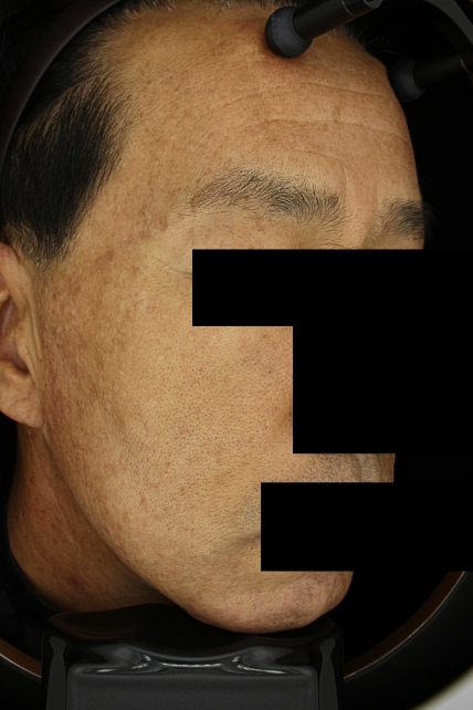 기미·색소 치료 후 사진 03