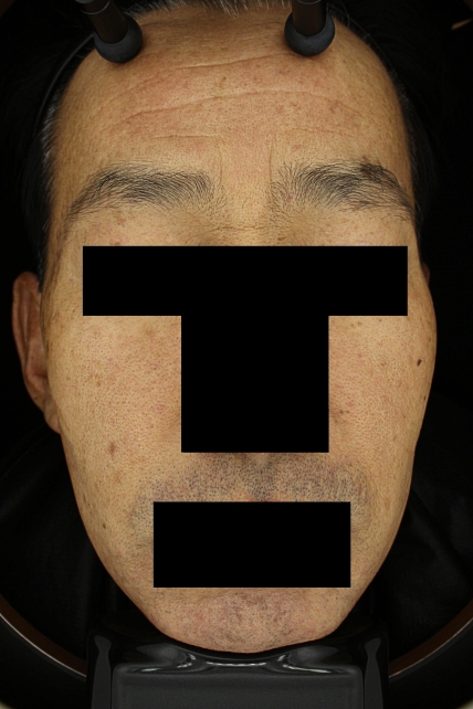 기미·색소 치료 전 대표 사진 70