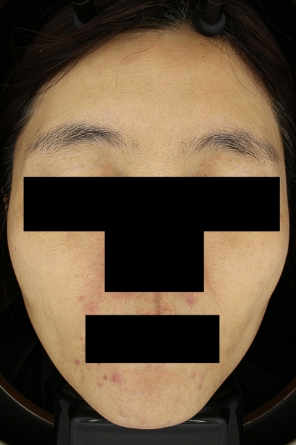 기미·색소 치료 후 대표 사진 71