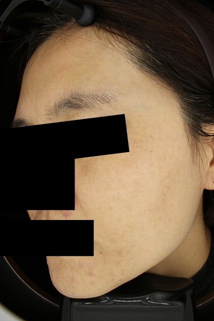 기미·색소 치료 후 사진 02