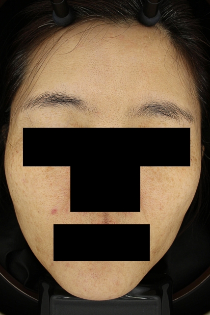 기미·색소 치료 전 대표 사진 71