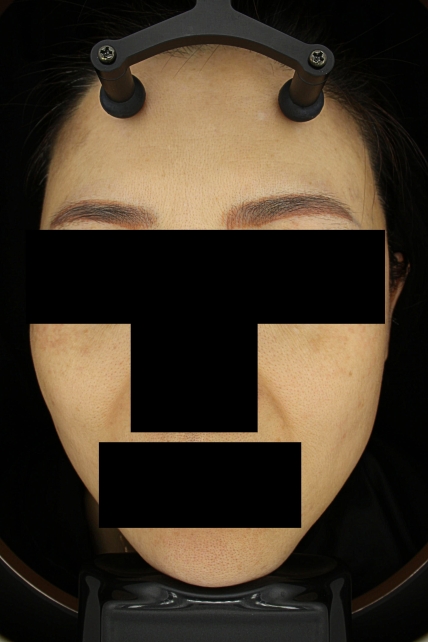 기미·색소 치료 후 대표 사진 73