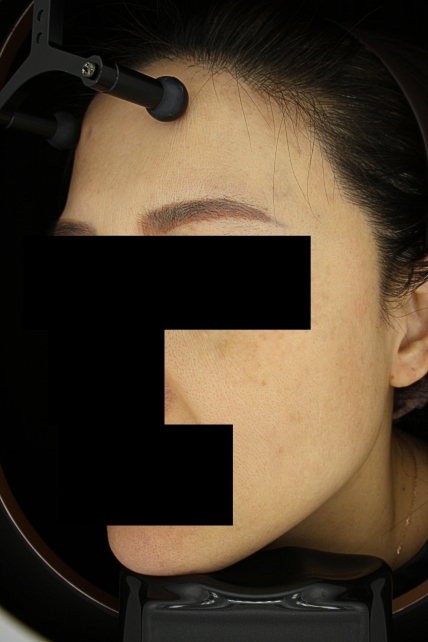 기미·색소 치료 후 사진 02