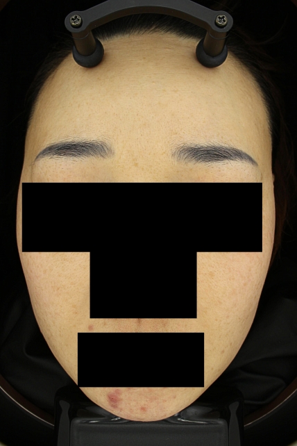 기미·색소 치료 후 대표 사진 74