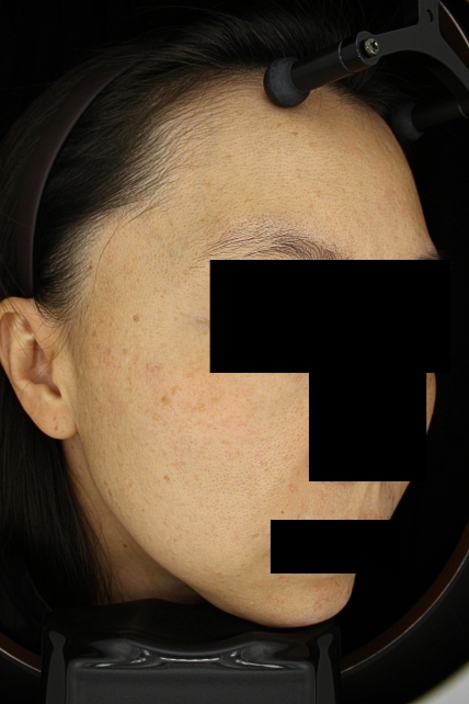 기미·색소 치료 전 사진 03