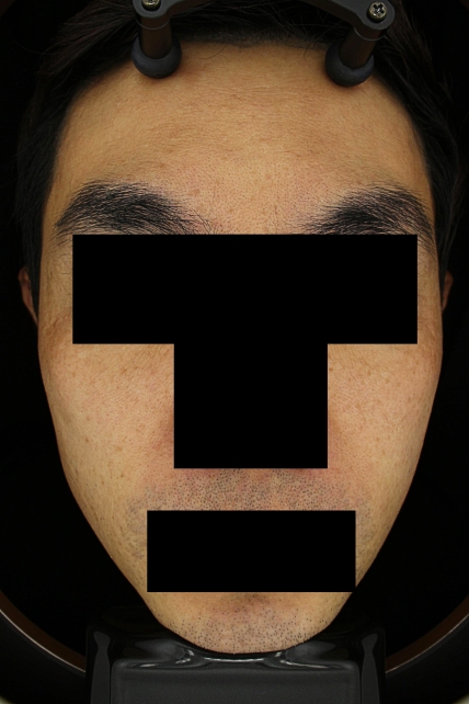 기미·색소 치료 후 대표 사진 76