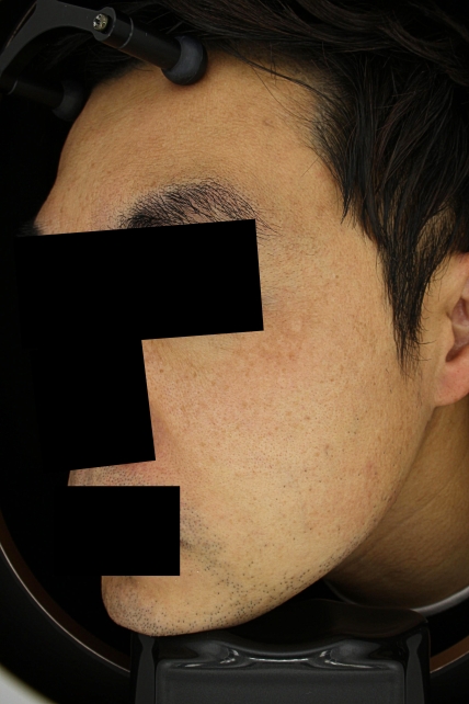 기미·색소 치료 후 사진 02