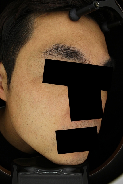 기미·색소 치료 후 사진 03