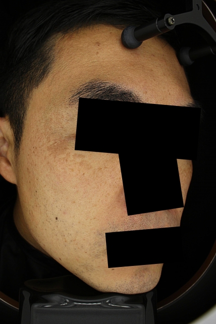 기미·색소 치료 전 사진 03