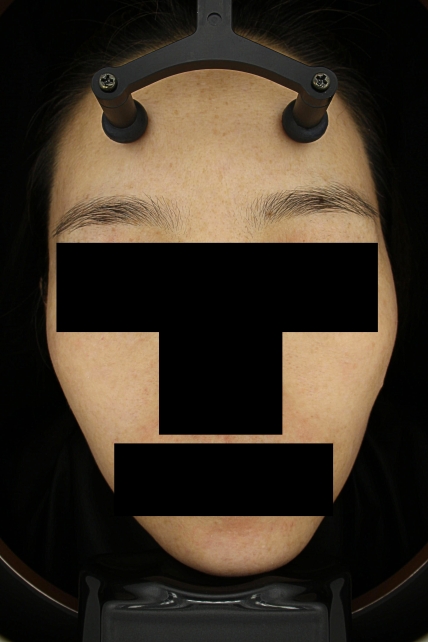 기미·색소 치료 후 대표 사진 77
