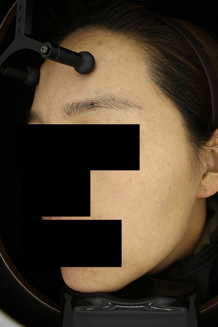 기미·색소 치료 후 사진 02