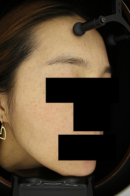 기미·색소 치료 전 사진 03