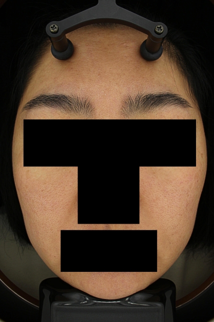 기미·색소 치료 후 대표 사진 78