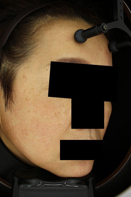 기미·색소 치료 전 사진 03