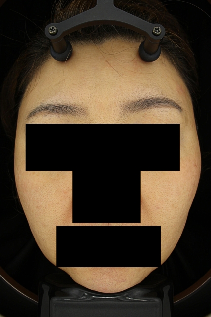 기미·색소 치료 후 대표 사진 80