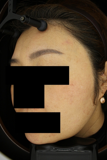 기미·색소 치료 후 사진 02